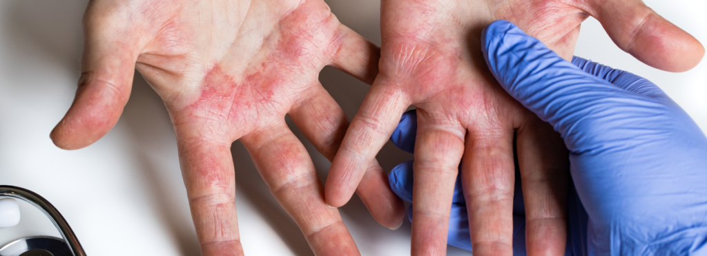 Understanding Dermatitis: Types, Symptoms, & Treatment